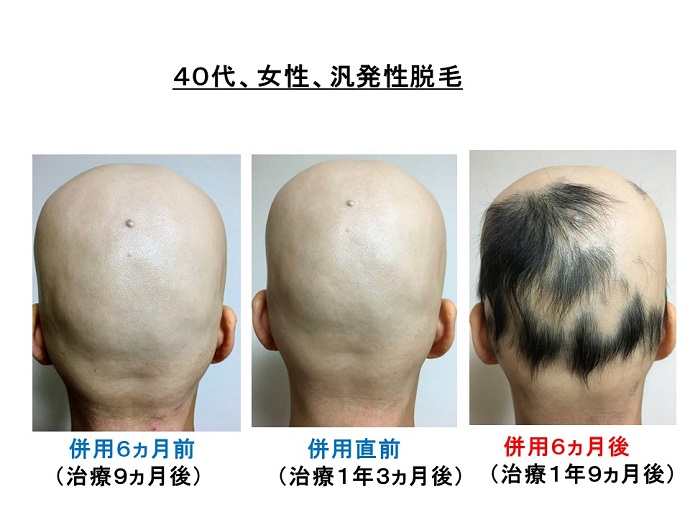 汎発性脱毛　病院